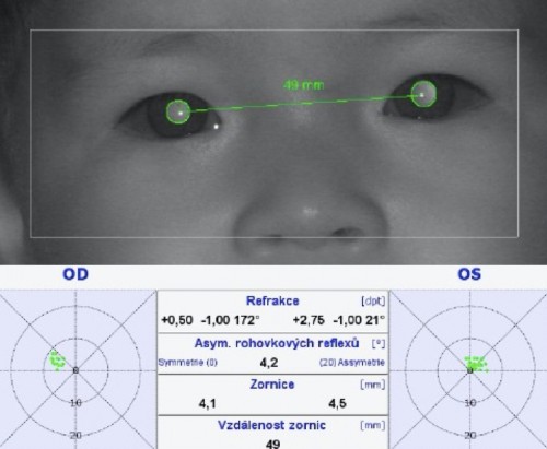 Dětské oční centrum, PlusOptix